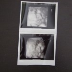 Ultrasound is amazing Ultrasound is amazing
