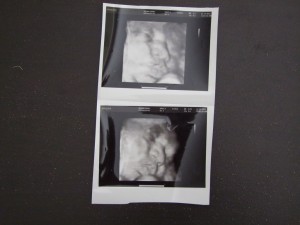Ultrasound is amazing